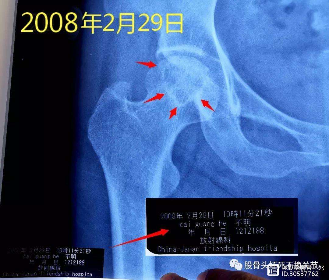 衡阳人工骨头医保报销多少(人工骨头医保报销多少比例)